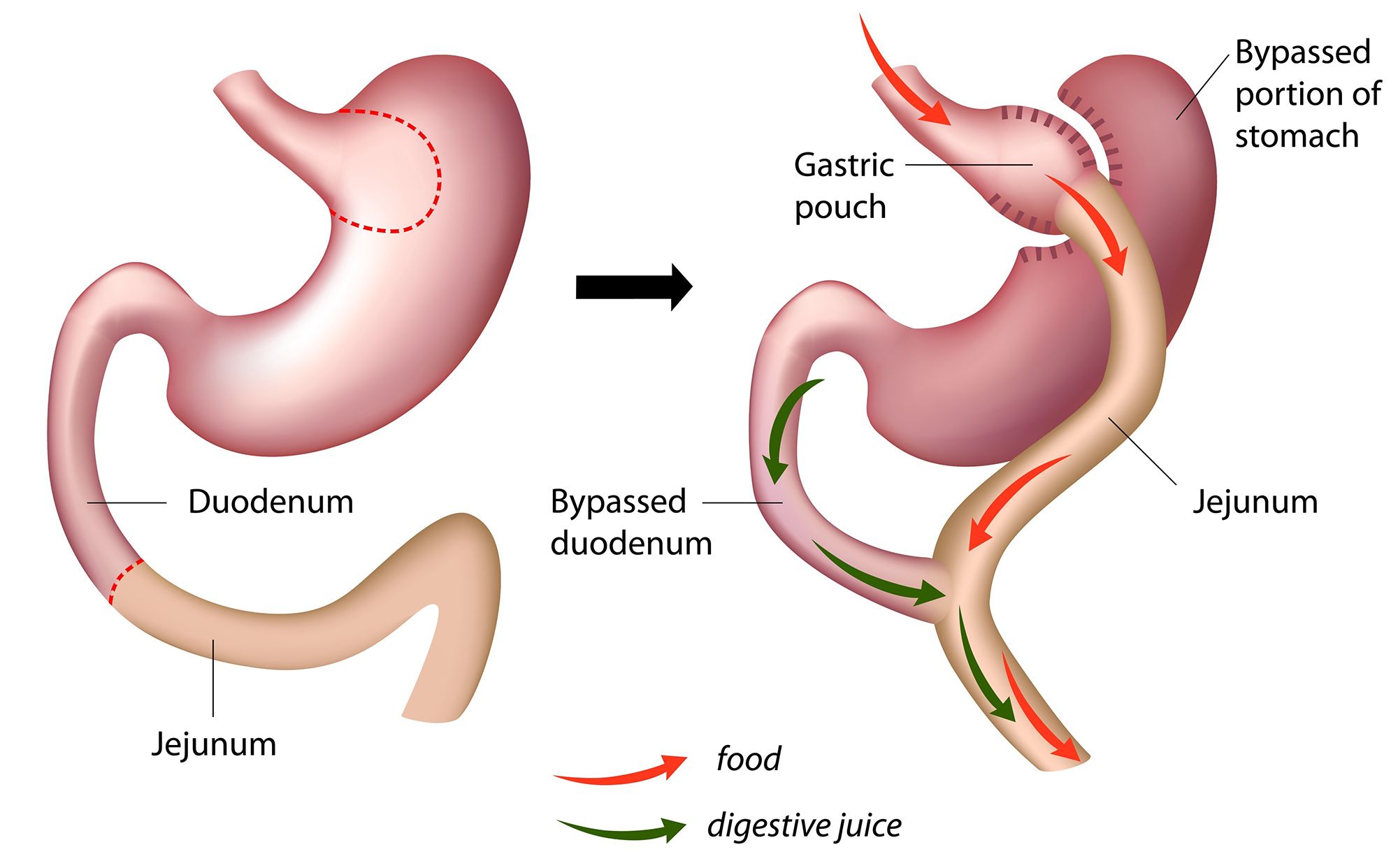 Gastric bypass weight loss surgery procedure in Royal Oak, Michigan