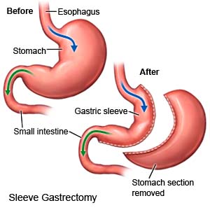 Sleeve gastrectomy weight loss surgery procedure in Michigan
